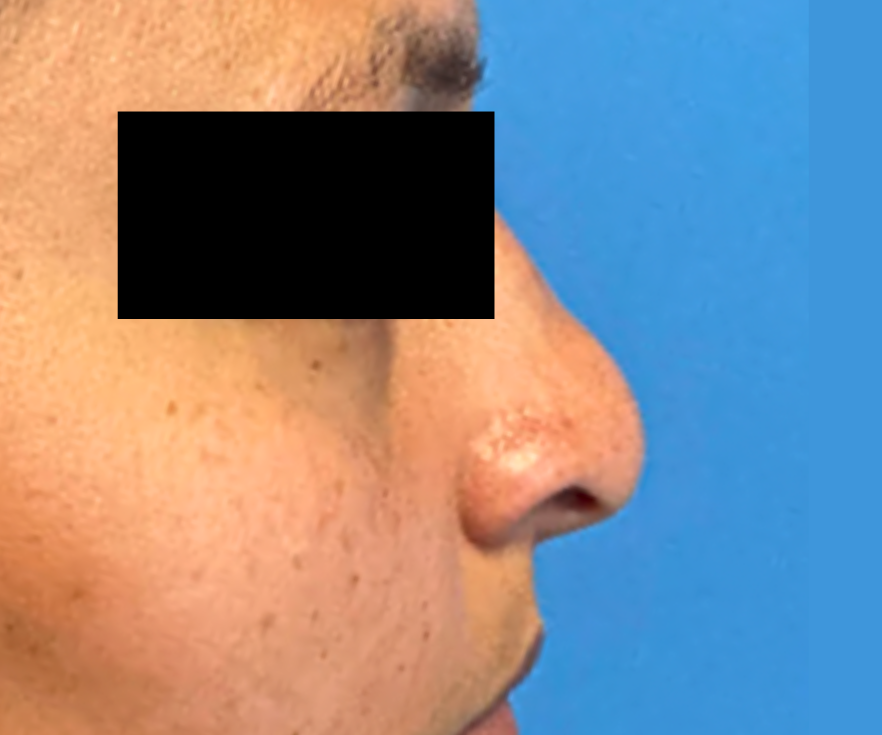 RHINOPLASTY--Case-Study-9427 | After Rhinoplasty