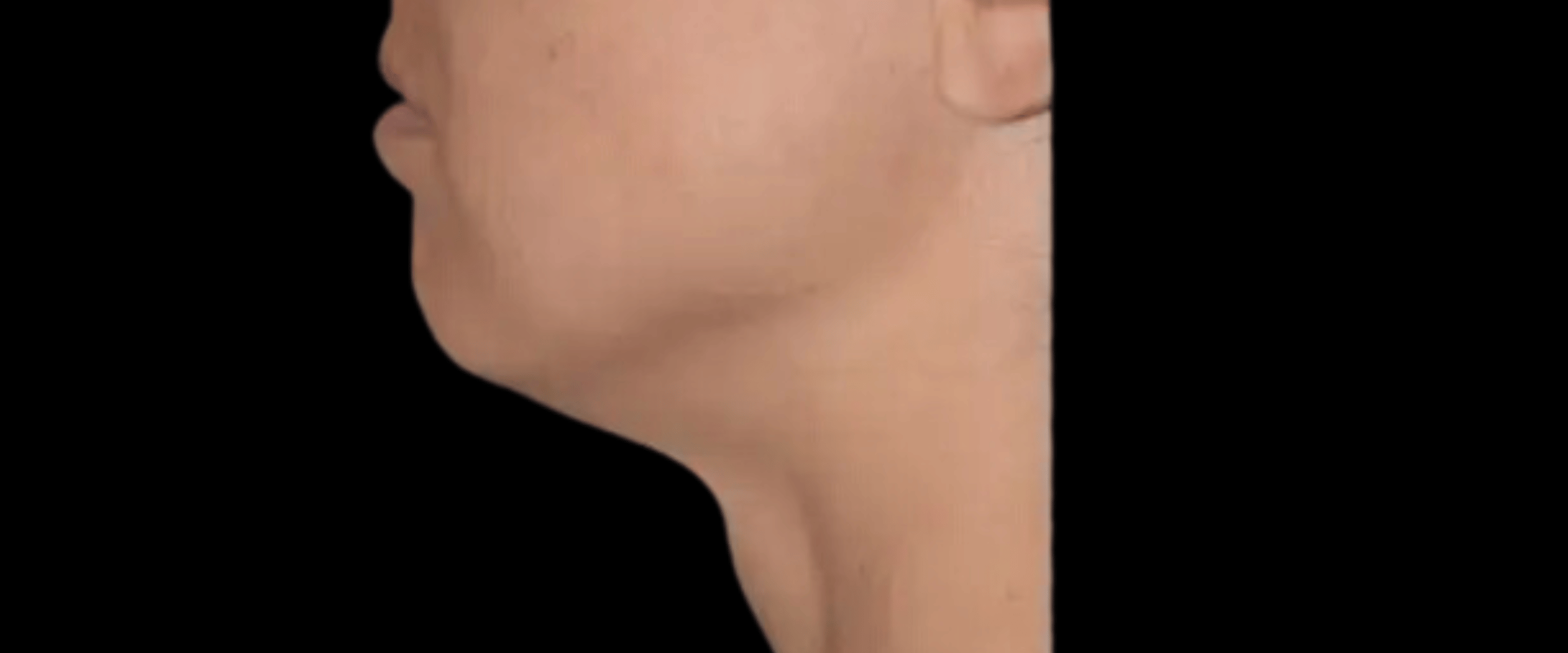 FaceTite--Case-Study-2840 | Before FaceTite