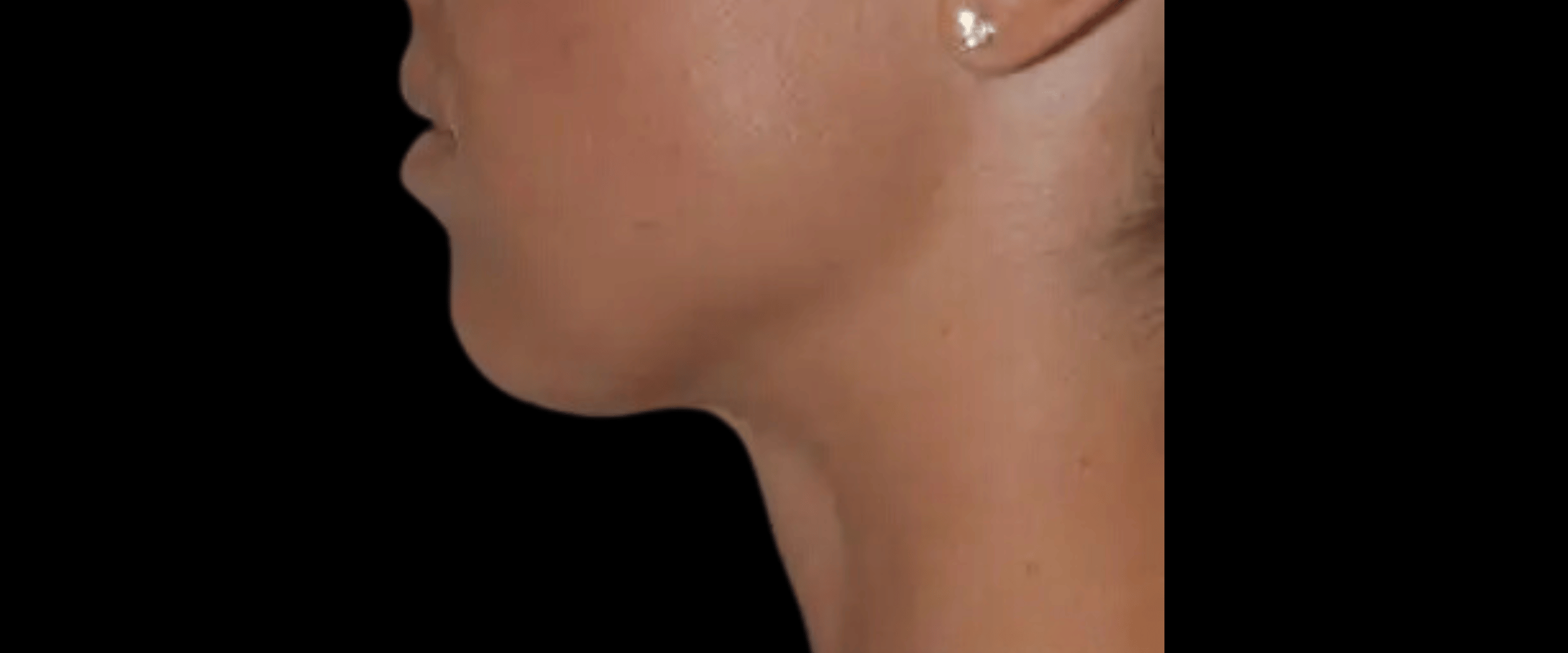 FaceTite--Case-Study-2840 | After FaceTite