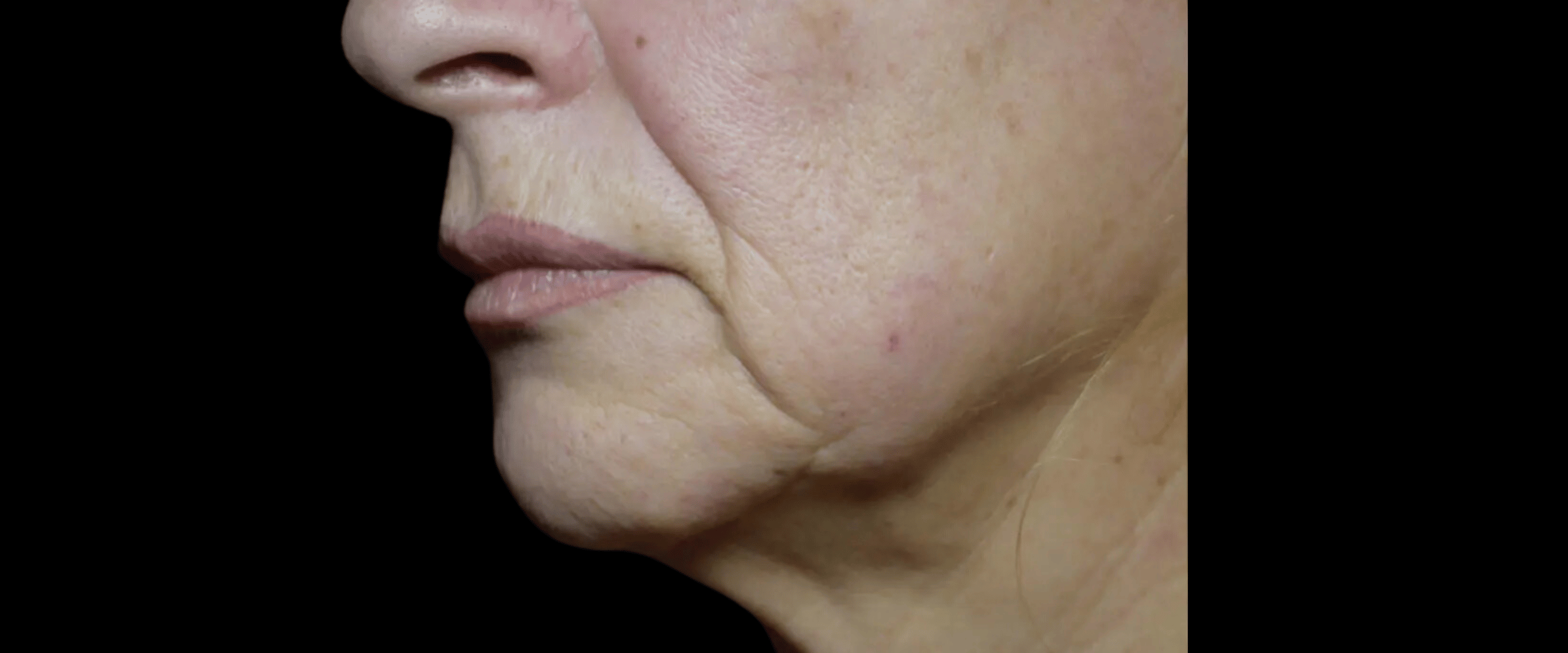 FaceTite--Case-Study-5286 | Before FaceTite