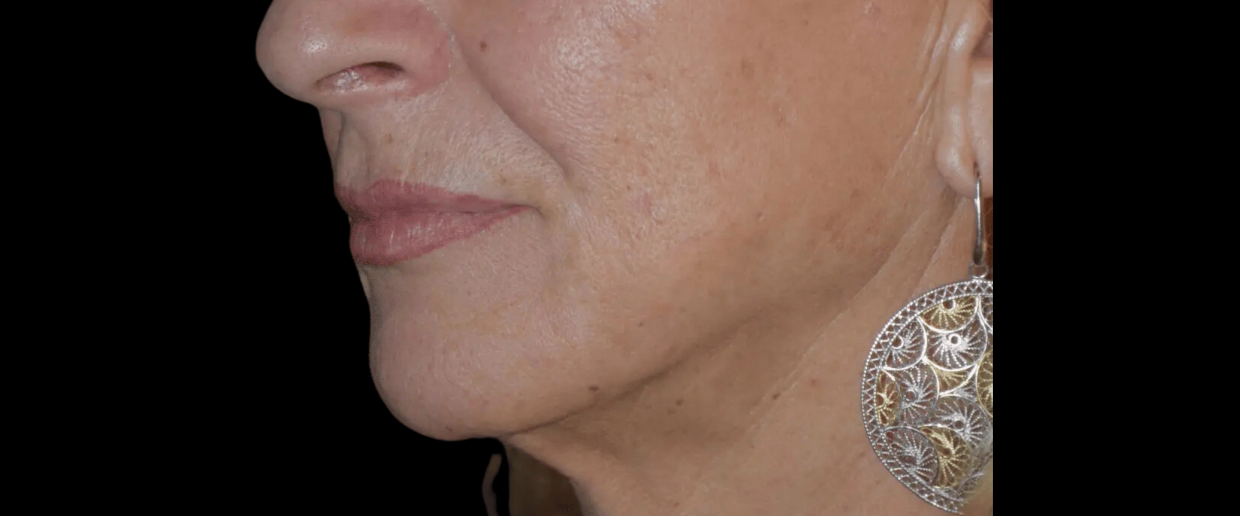 FaceTite--Case-Study-5286 | After FaceTite