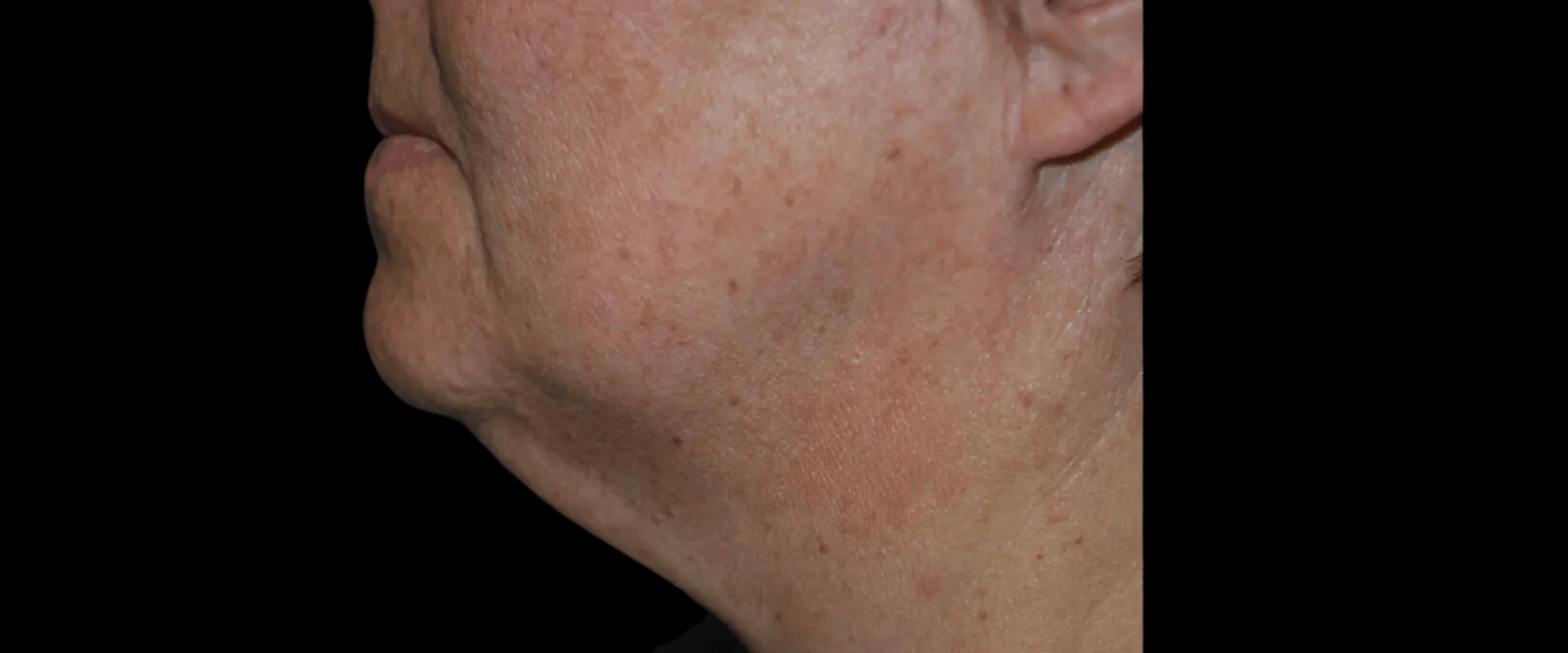 FaceTite--Case-Study-3742 | Before FaceTite