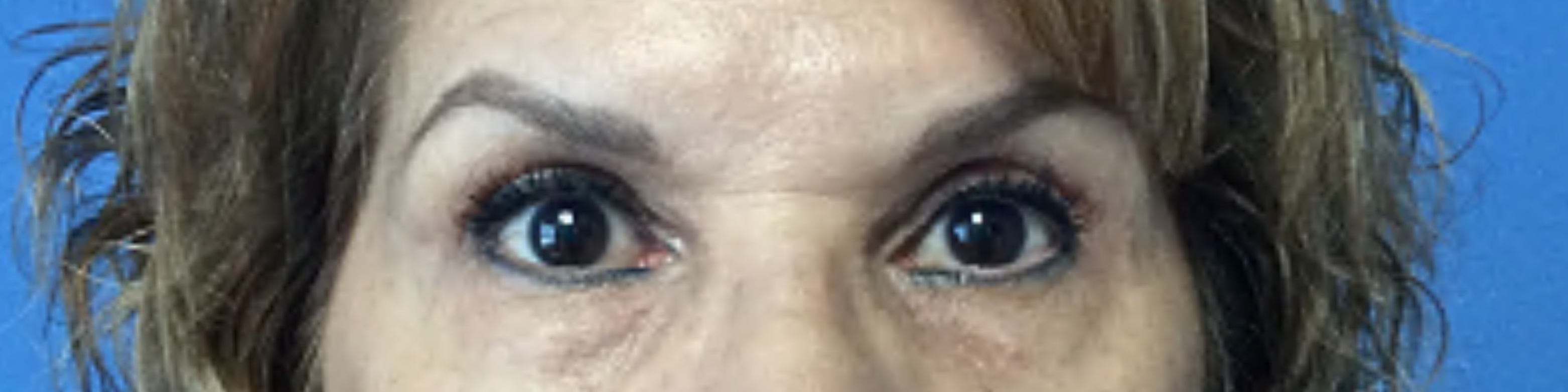 Upper-Blepharoplasty--Case-Study-4299 | After Blepharoplasty