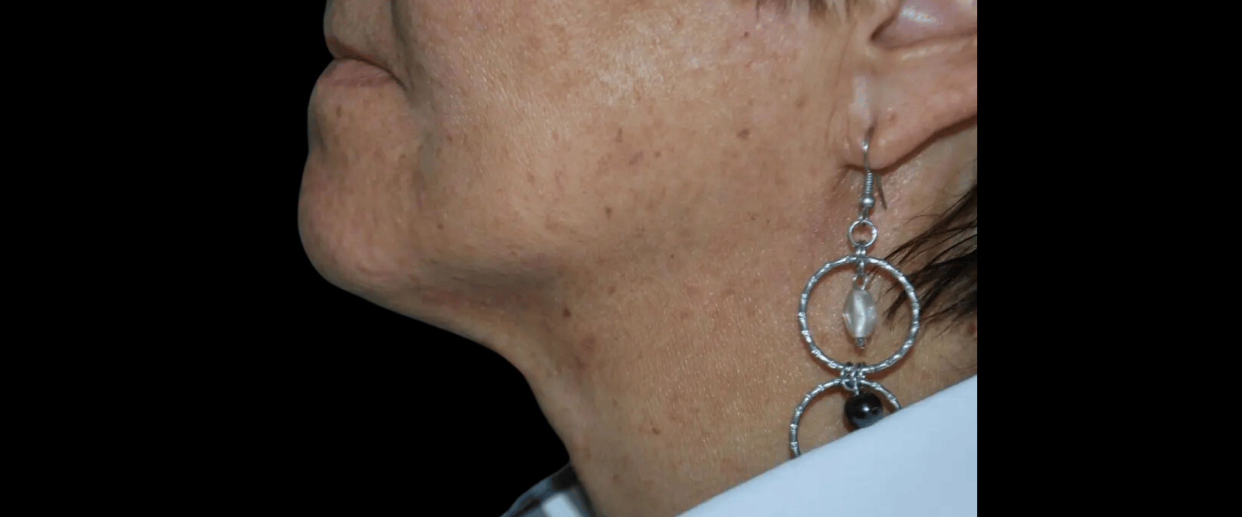 FaceTite--Case-Study-3742 | After FaceTite