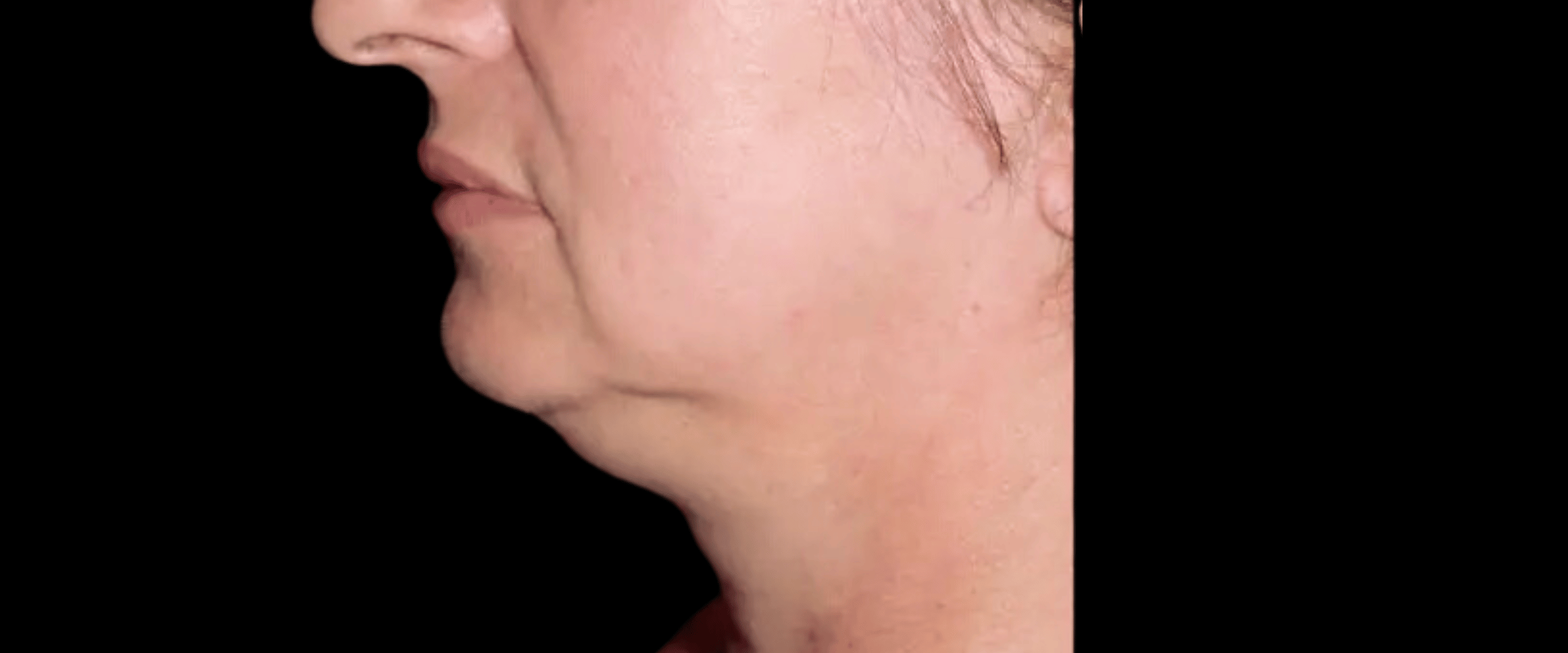 FaceTite--Case-Study-8195 | Before FaceTite