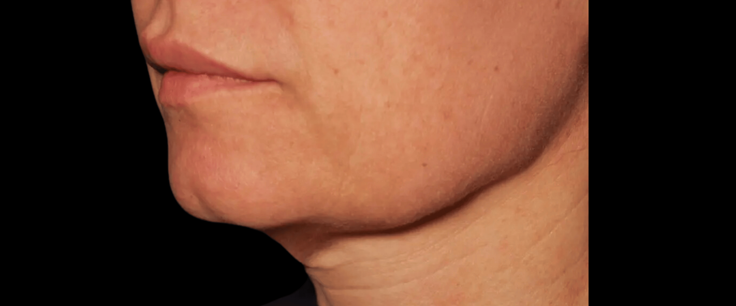 FaceTite--Case-Study-2607 | Before FaceTite