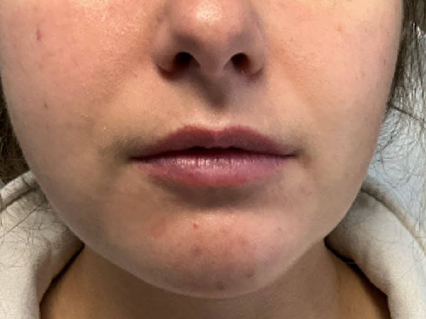 Lip-Filler--Case-Study-2748 | Before Non-surgical