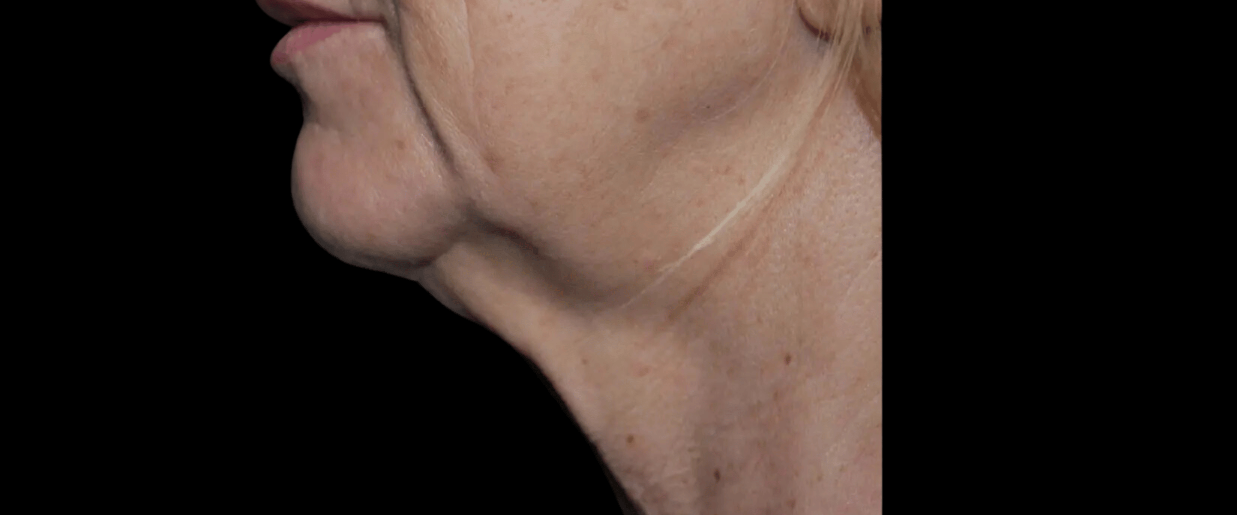 FaceTite--Case-Study-9538 | Before FaceTite