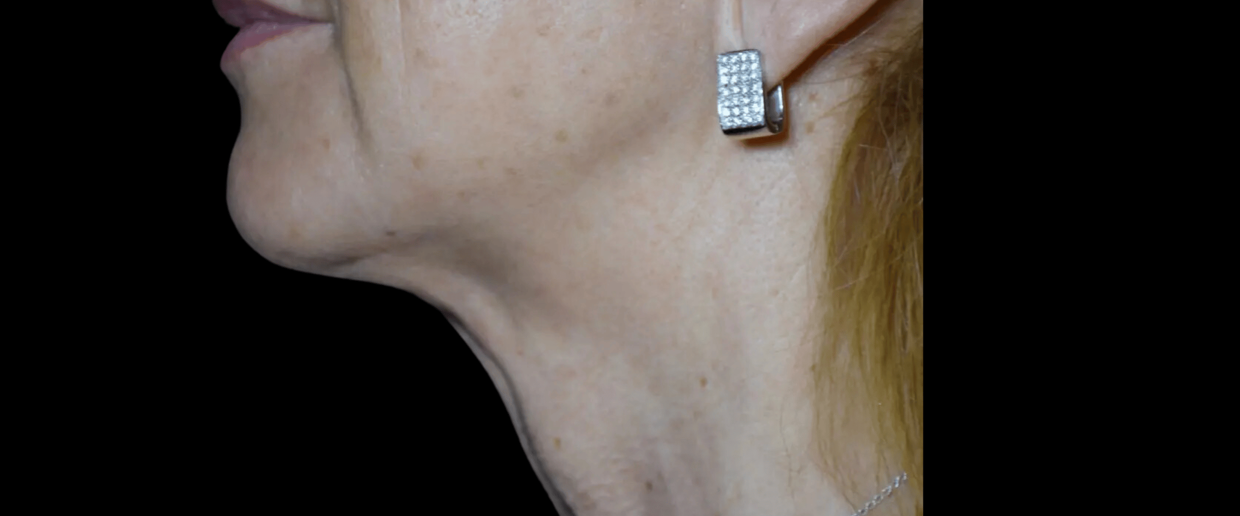 FaceTite--Case-Study-9538 | After FaceTite