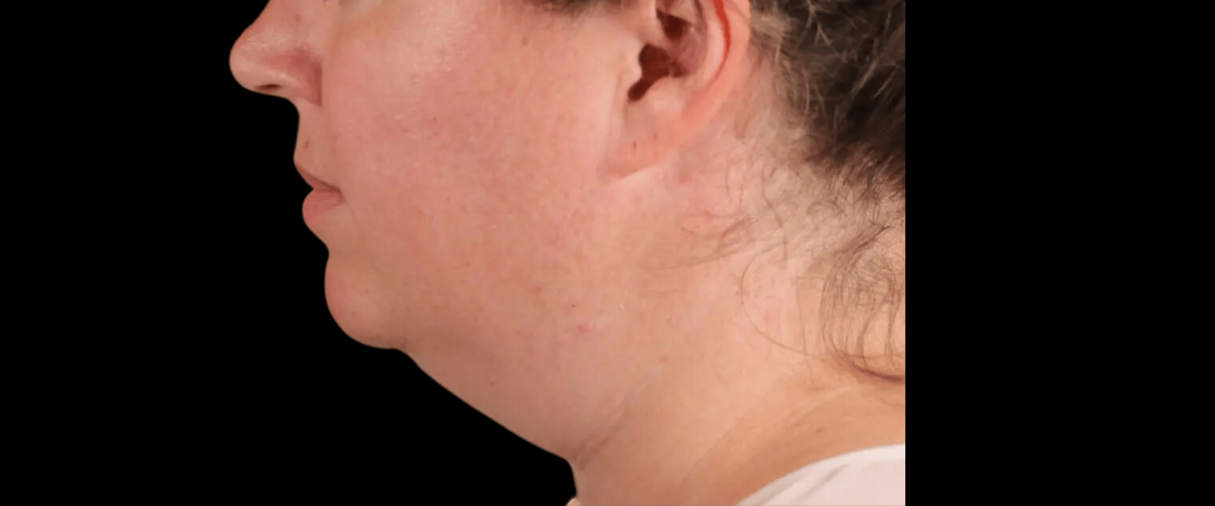 FaceTite--Case-Study-4716 | Before FaceTite