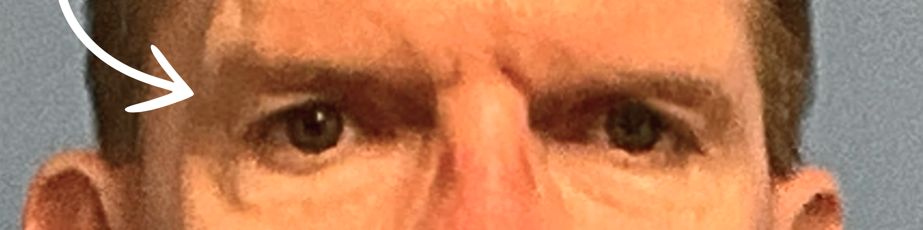 Upper-Blepharoplasty--Case-Study-5296 | Before Blepharoplasty