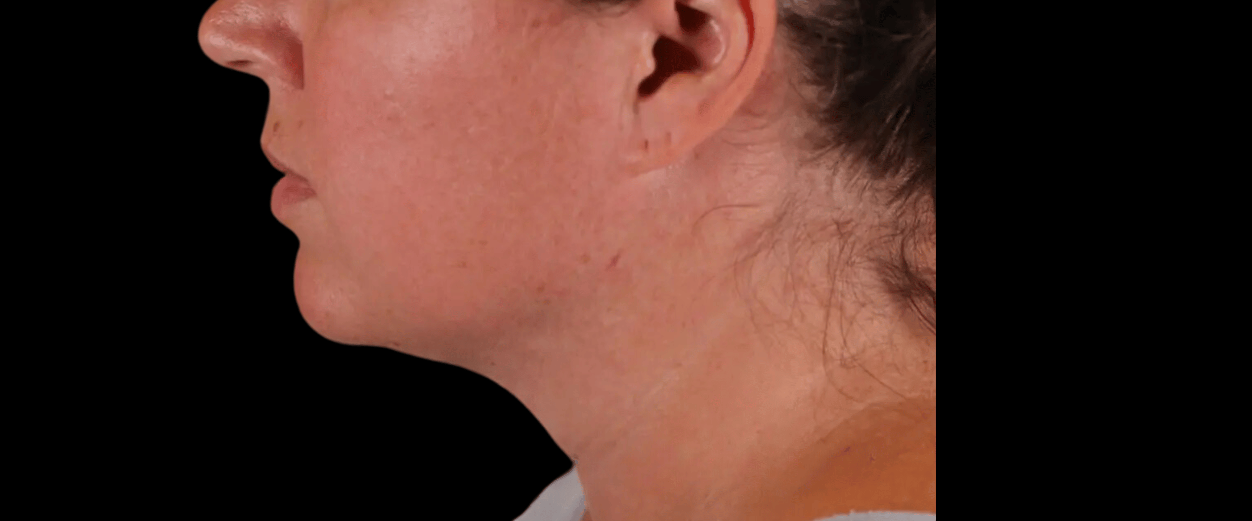 FaceTite--Case-Study-4716 | After FaceTite