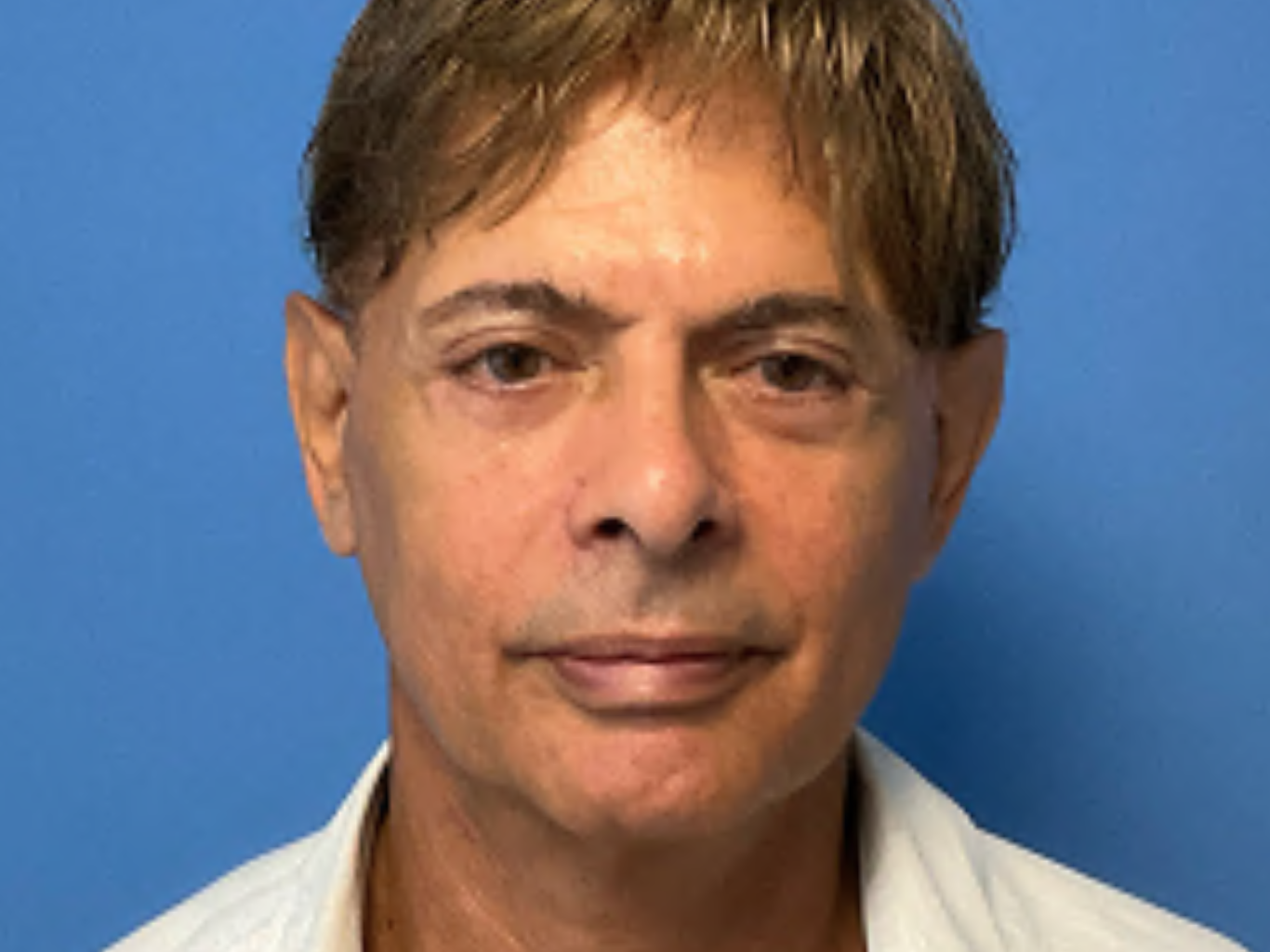 Facial-Rejuvenation---8211--Lower-Face-and-Neck-Lift--Blepharoplasty | After Facelift