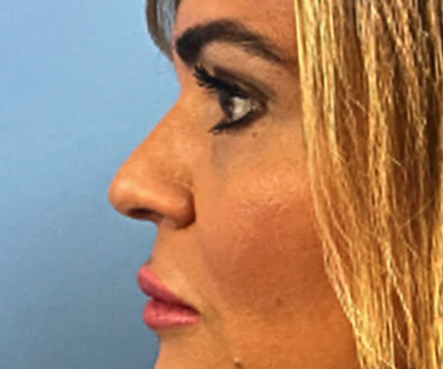RHINOPLASTY--Case-Study-3168 | After Rhinoplasty