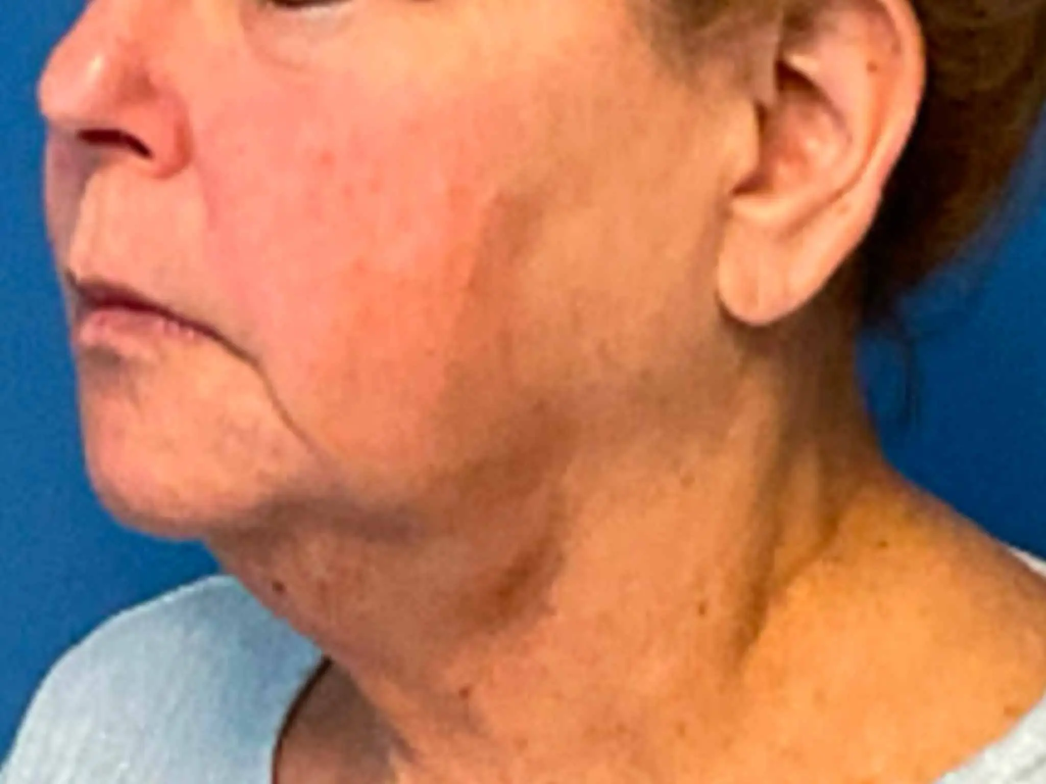 Neck-Lift--Case-10512 | Before Quiet Facelift