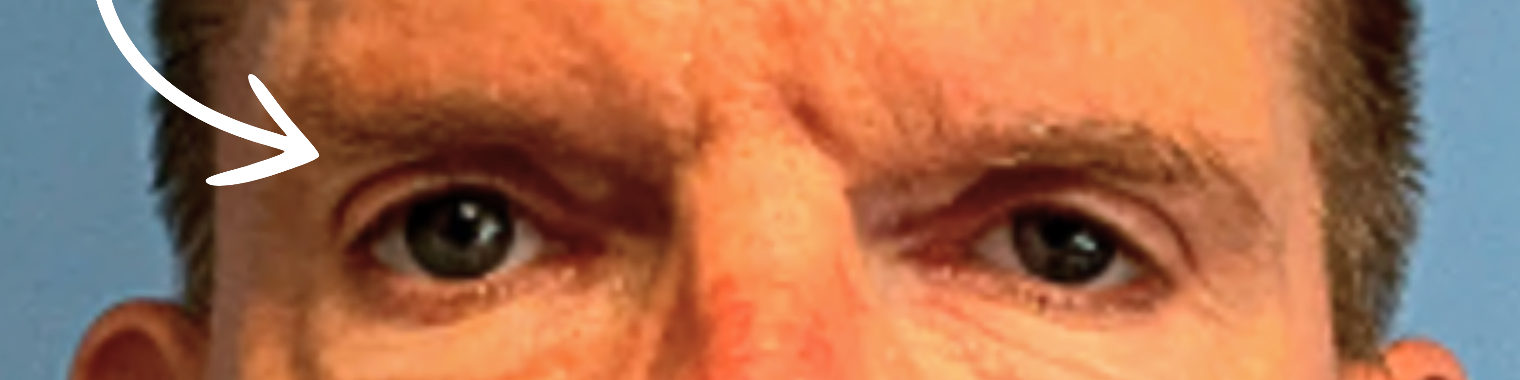 Upper-Blepharoplasty--Case-Study-5296 | After Blepharoplasty