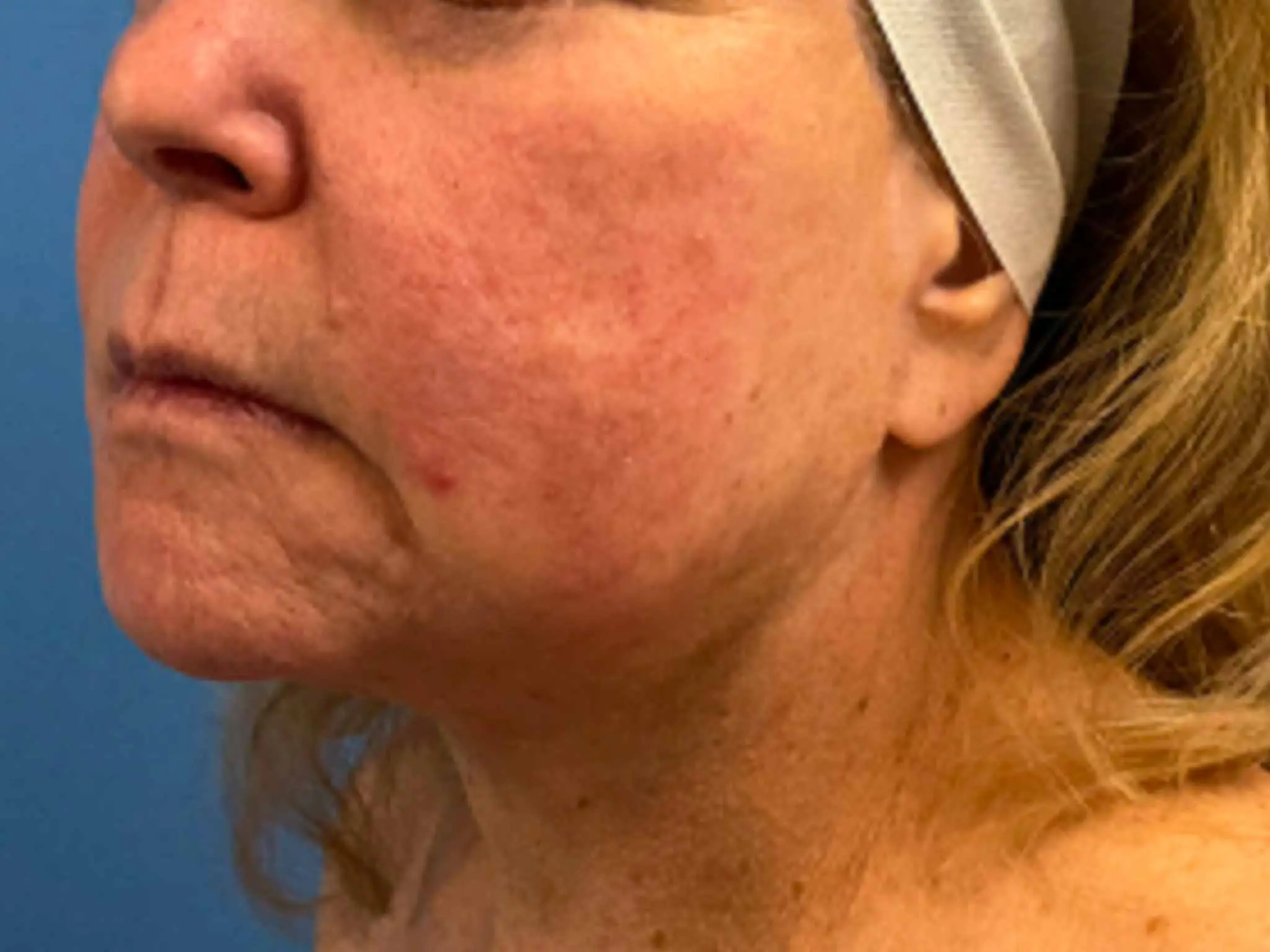 Neck-Lift--Case-10512 | After Quiet Facelift