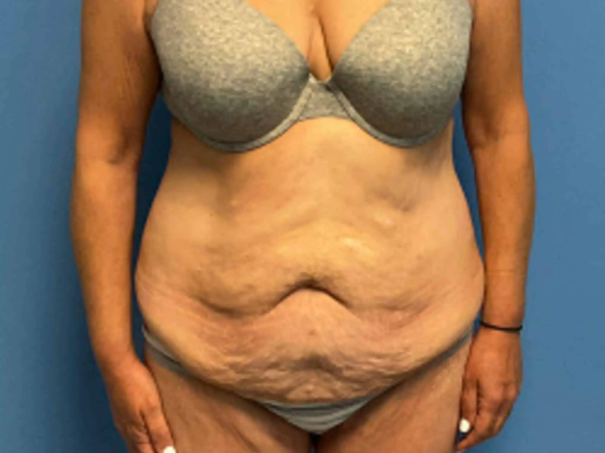 Fleur-de-Lis-abdominoplasty | Before Body