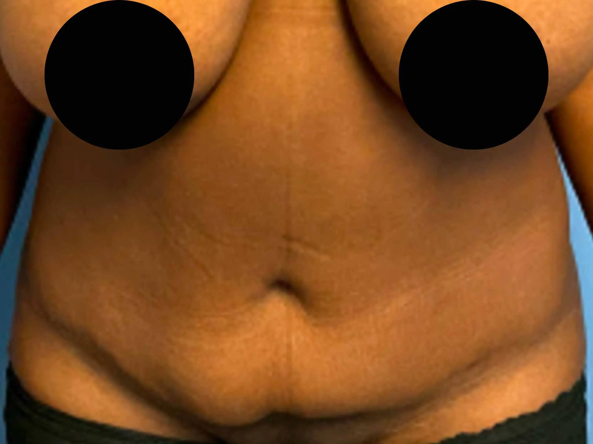 Tummy-Tuck--Case-1865 | Before Liposuction