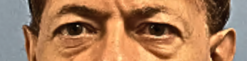 Blepharoplasty--Case-Study-1976 | Before Blepharoplasty