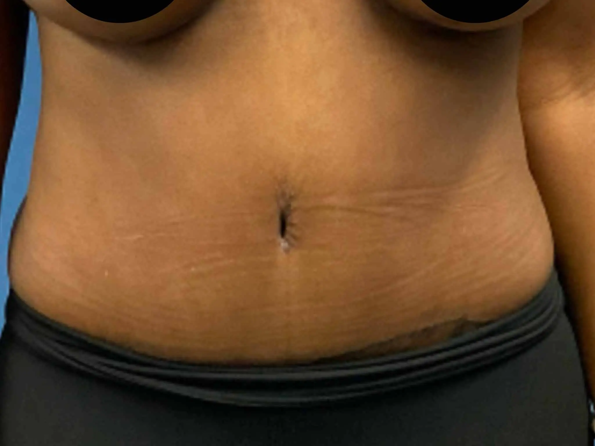 Tummy-Tuck--Case-1865 | After Liposuction