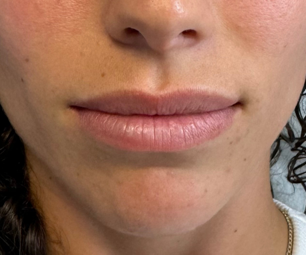 Lip-Filler--Case-Study-5193 | Before Non-surgical
