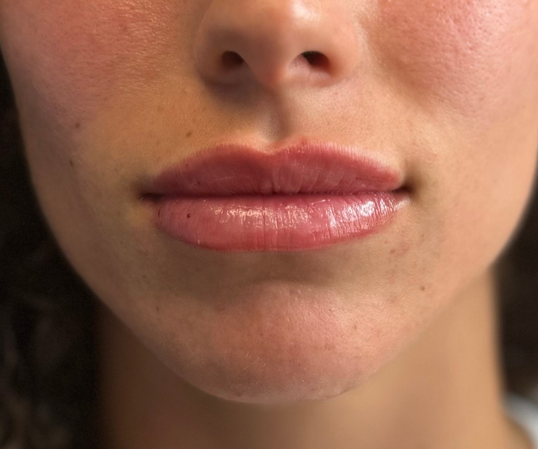 Lip-Filler--Case-Study-5193 | After Non-surgical