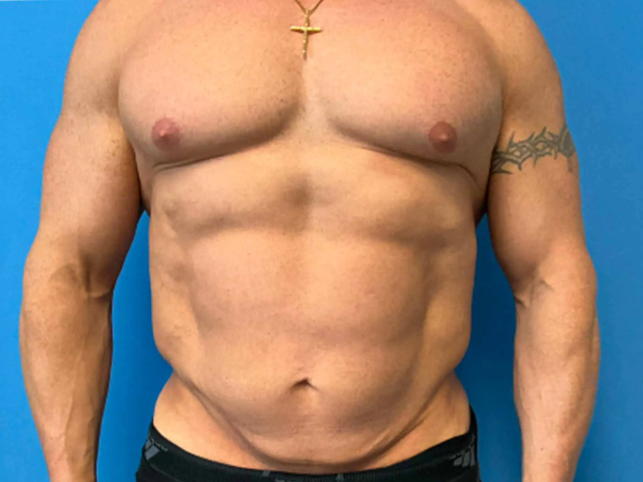 Tummy-Tuck--Case-5921 | After Male Tummy Tuck