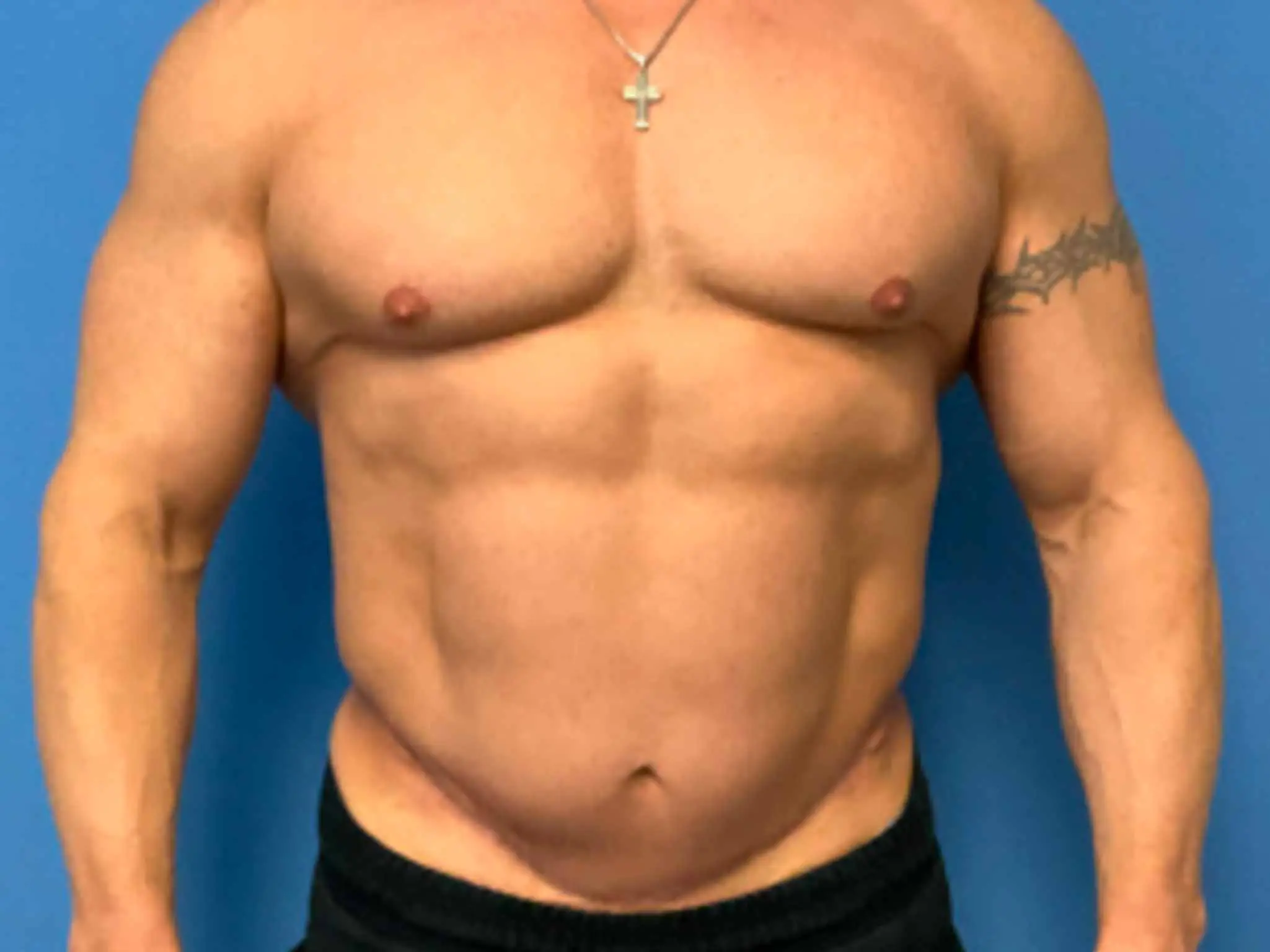 Tummy-Tuck--Case-5921 | Before Male Tummy Tuck