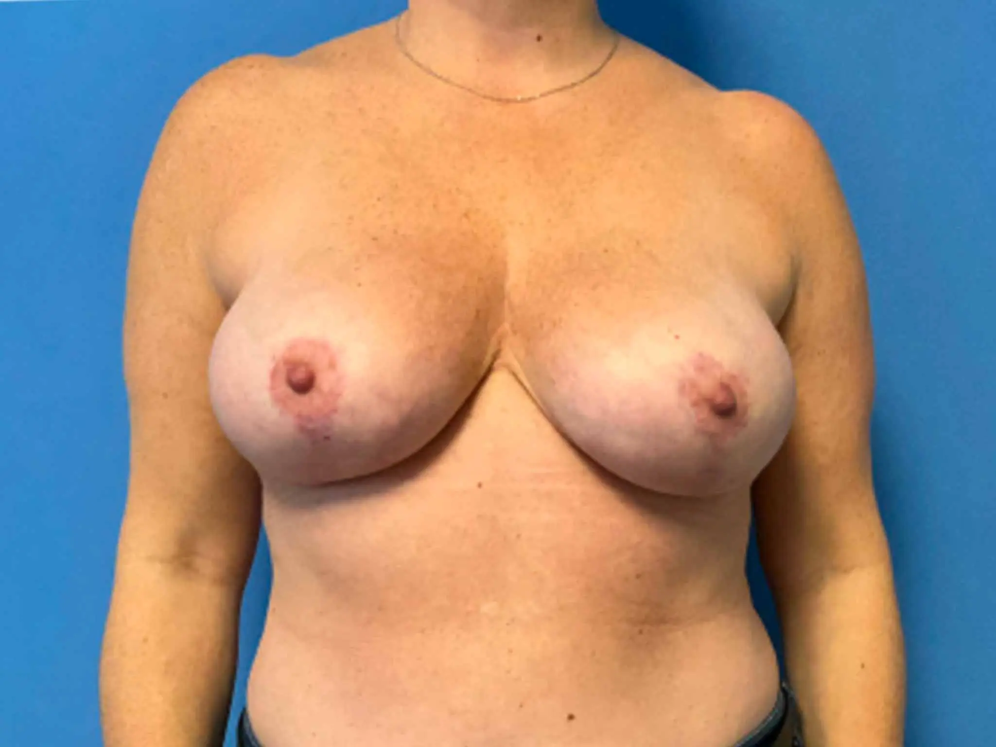 breast-reduction | After Breast