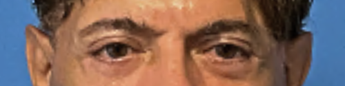 Blepharoplasty--Case-Study-1976 | After Blepharoplasty