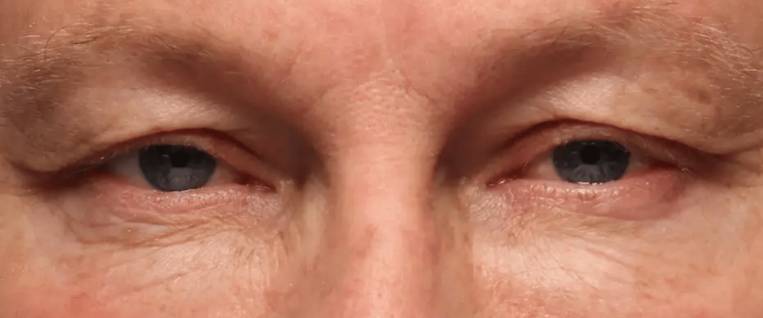 Facetite--amp--Accutite--Case-Study-7482 | Before AccuTite