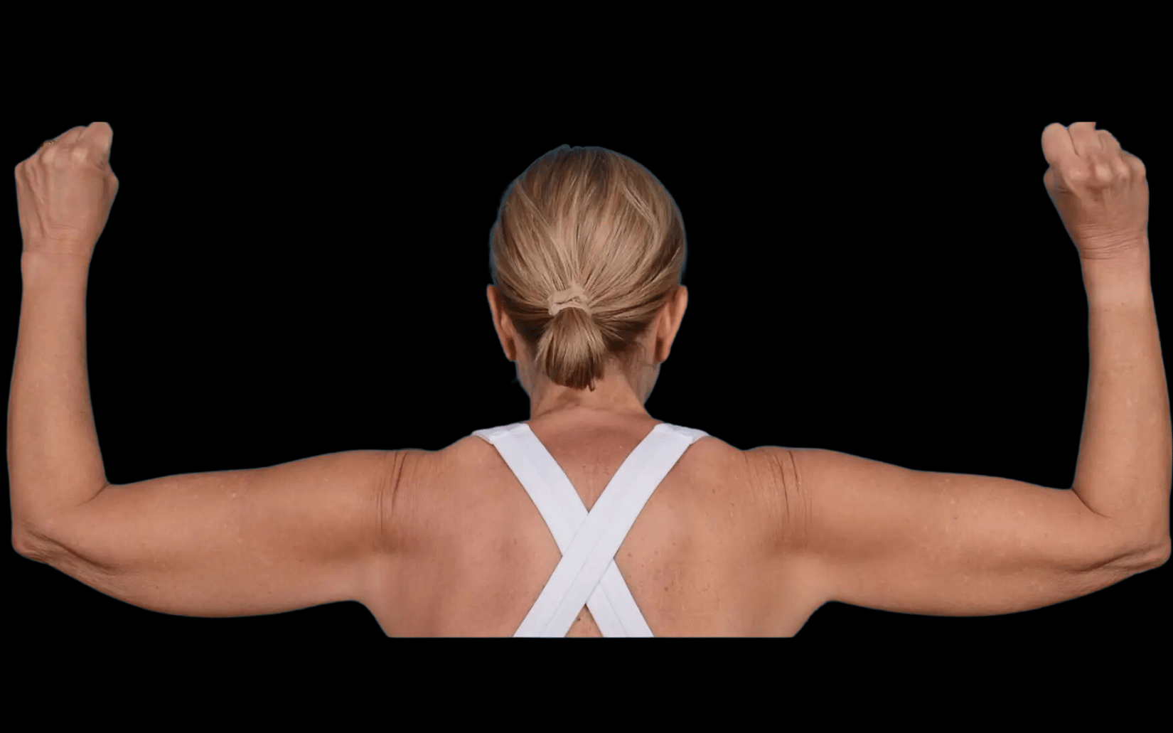 BodyTite--Case-Study-3591 | Before BodyTite