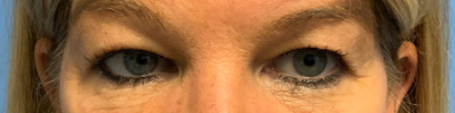 Blepharoplasty-With-Accutite | Before AccuTite