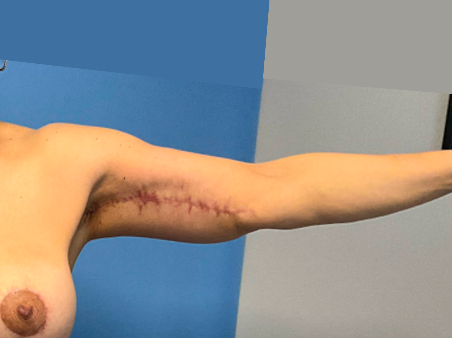 arm-lift--case-3009 | After Body