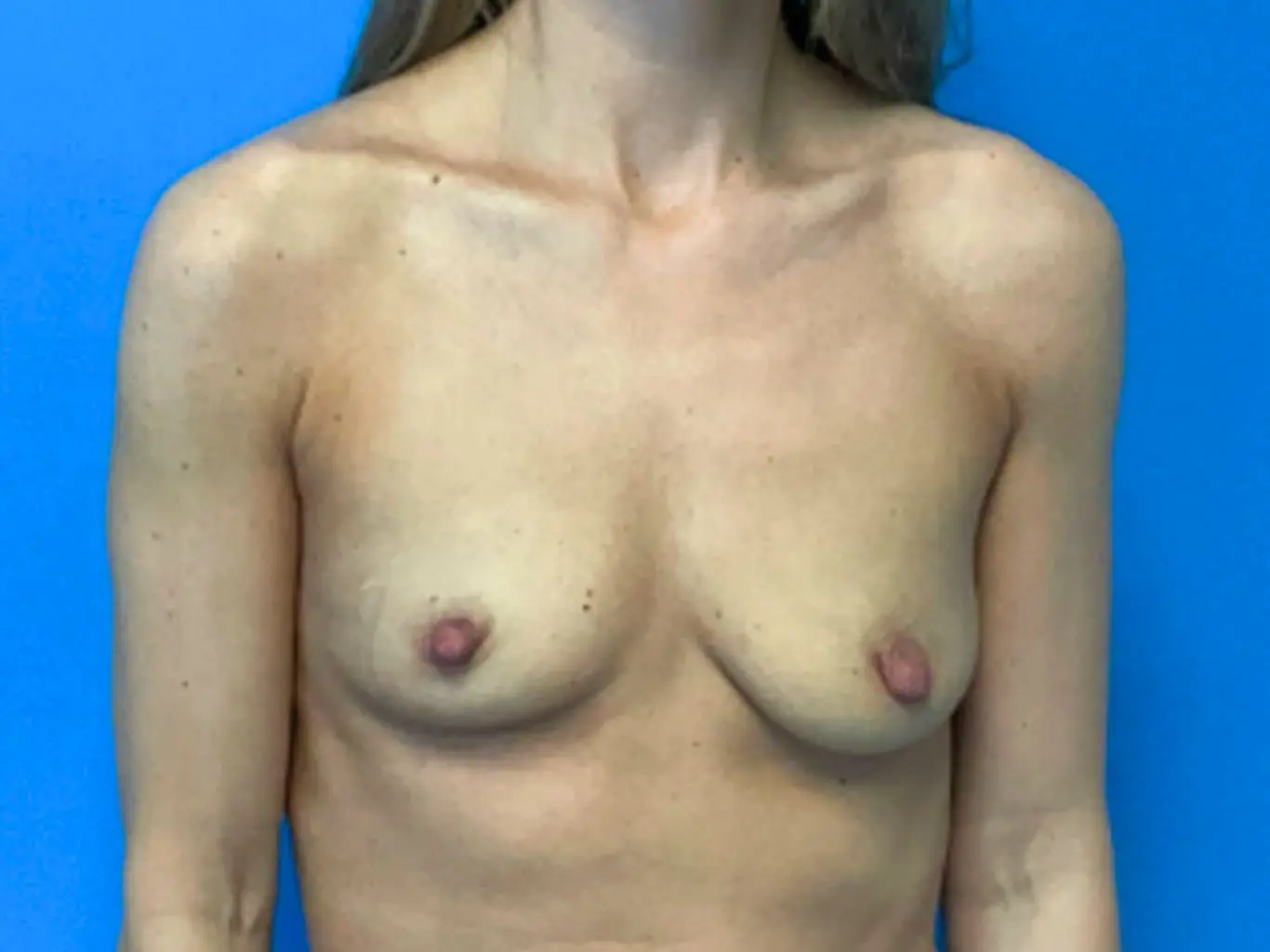 Breast-augmention-with-lift--Case-4398 | Before Breast Augmentation