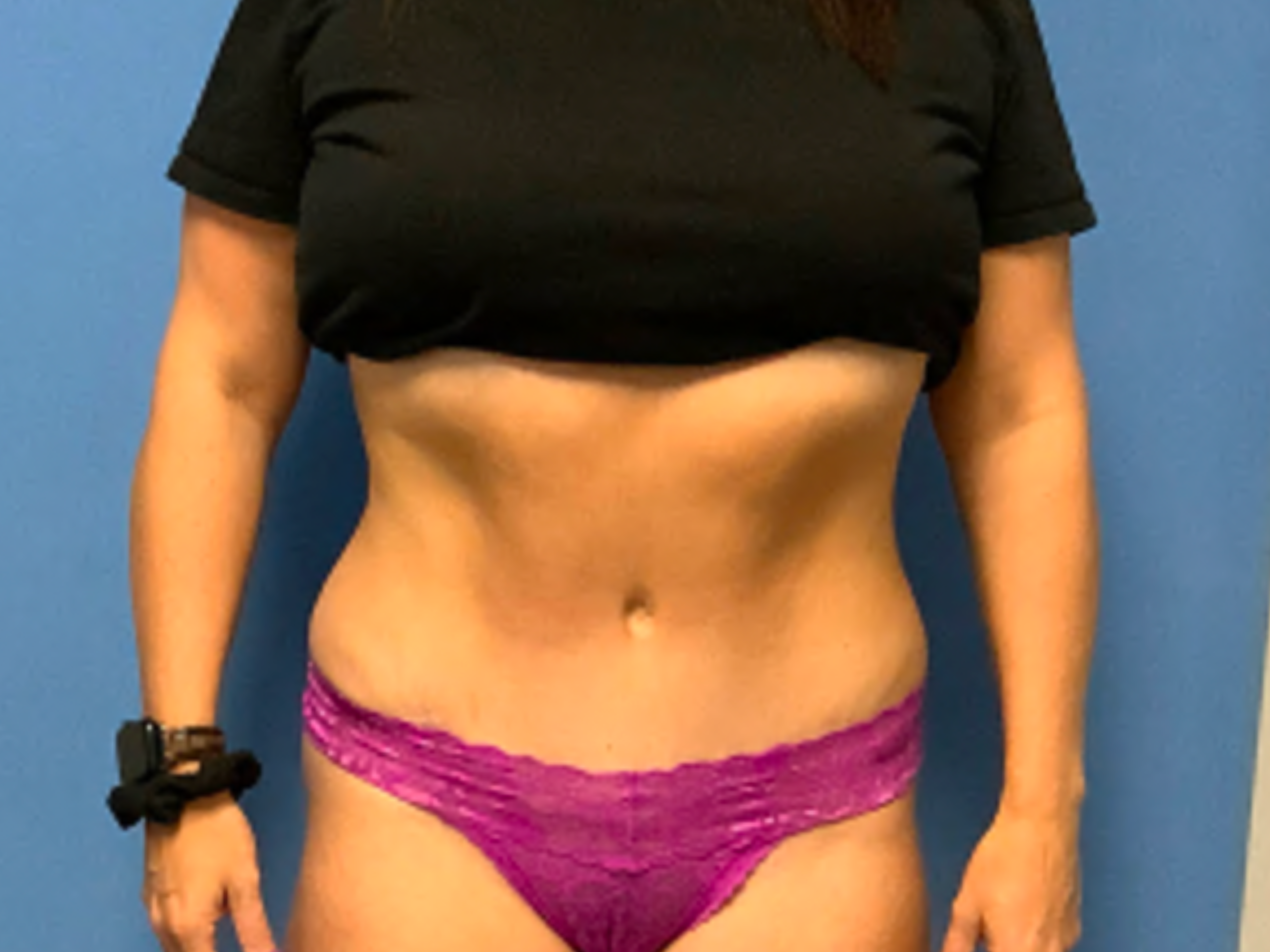 tummy-tuck-with-liposuction--case-1536 | After Liposuction