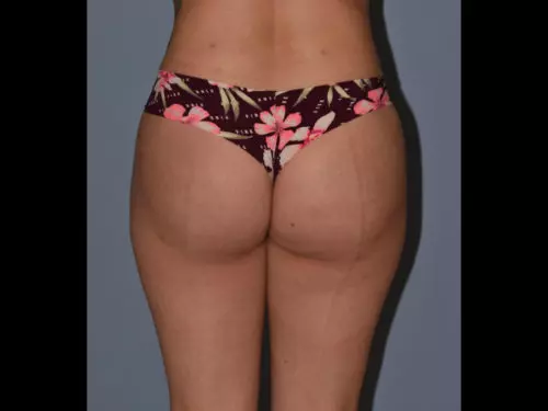 Brazilian-Butt-Lift--Case-Study-7395 | After Body