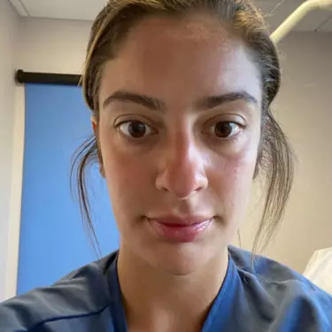 Rhinoplasty--Case-Study-7521 | Before Rhinoplasty