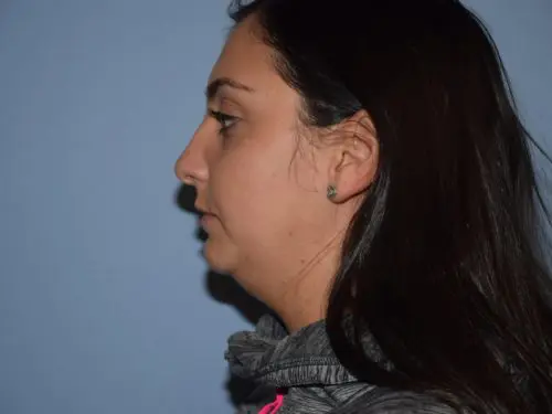 Chin-Augmentation--Case-Study-2957 | Before Chin Augmentation