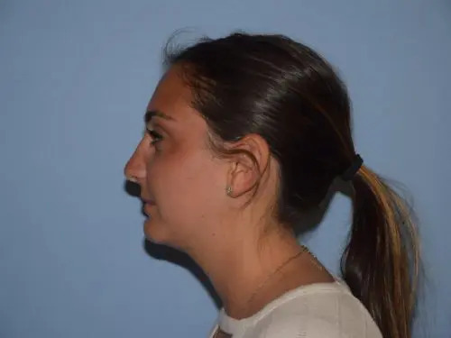 Chin-Augmentation--Case-Study-2957 | After Chin Augmentation