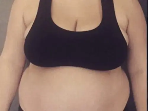 Mommy-Makeover--Case-Study-4072 | Before Body
