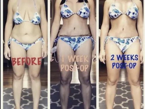 Mommy-Makeover--Case-Study-4072 | After Body