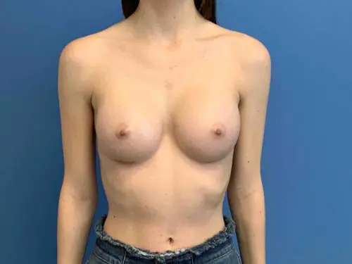 Breast-Augmentation--Case-Study-5196 | After Breast Augmentation