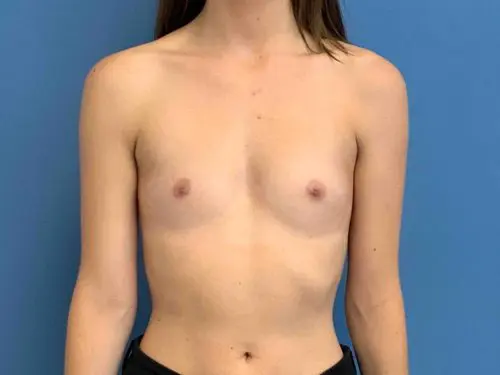 Breast-Augmentation--Case-Study-5196 | Before Breast Augmentation