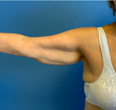 Arm-Lift--Case-Study-8629 | Before Body