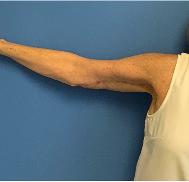 Arm-Lift--Case-Study-8629 | After Body