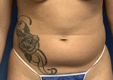 Liposuction--Case-Study-7601 | Before Body