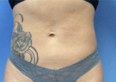 Liposuction--Case-Study-7601 | After Body