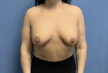 Breast-Revision-with-Lift--Case-study-3746 | Before Breast Revision